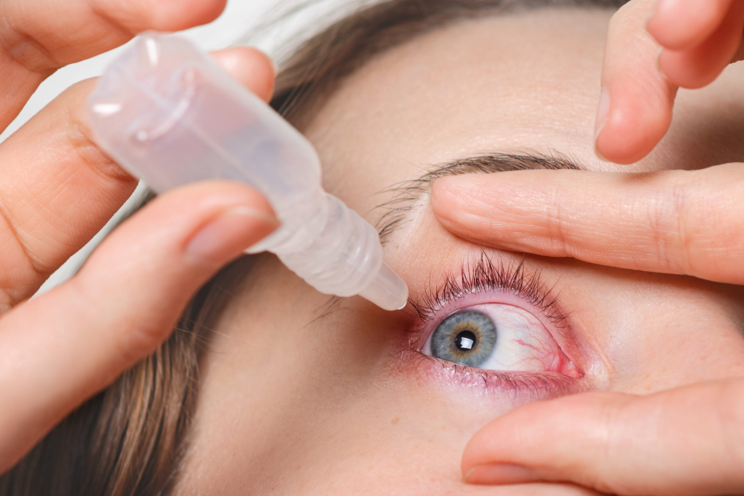 Conjuntivitis girona